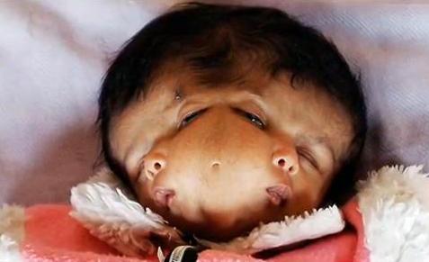 mutated 2 Two headed baby Fukushima Radiation Nuclear Chernobyl Iraq depleted Uranium