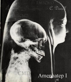 Image of Amenhatep I the X-ray of his malformed skull of the mummy Amenhatep from Colette Dowell private photograph collection